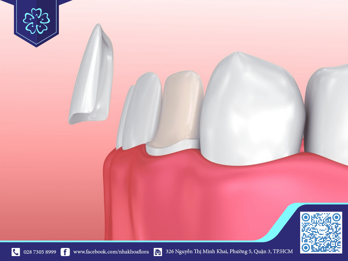 Porcelain dental wrap is the technique of covering the entire tooth with porcelain