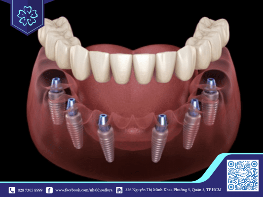 Trồng răng Implant được phát triển theo phương pháp All on 6 Trồng răng Implant được phát triển theo phương pháp All on 6