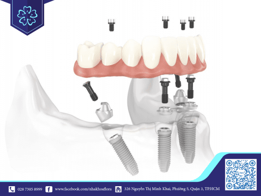 trong-rang-implant-all-on-four Phương pháp trồng răng Implant all on 4