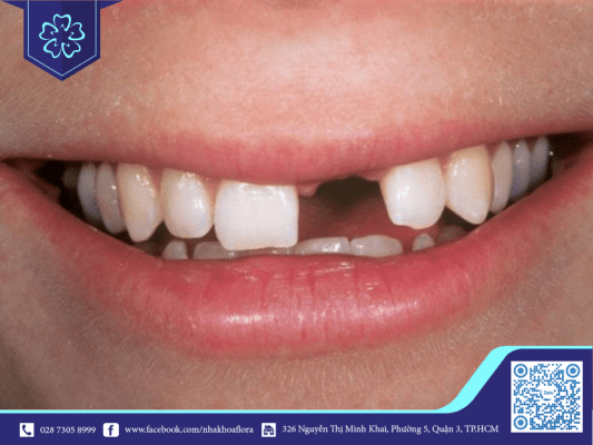 Trụ Implant - vật liệu tốt nhất cho xương hàm của bạn nếu gặp tình trạng mất răng (ảnh minh họa) Trụ Implant - vật liệu tốt nhất cho xương hàm của bạn nếu gặp tình trạng mất răng (ảnh minh họa)