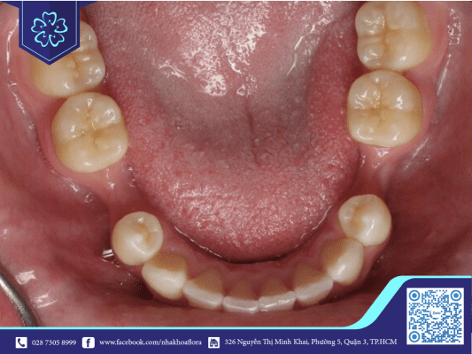 Xương hàm sẽ bị tiêu khi răng hàm bị mất lâu ngày nhưng không được thay thế bằng răng Implant (ảnh minh họa) Xương hàm sẽ bị tiêu khi răng hàm bị mất lâu ngày nhưng không được thay thế bằng răng Implant (ảnh minh họa)