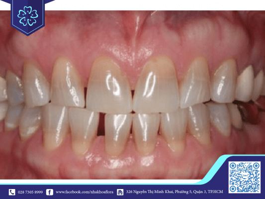 [ƯU ĐÃI] Chi phí bọc 2 hàm răng toàn sứ giá bao nhiêu | Nha khoa Flora 3