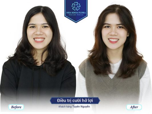 khach-hang-chua-cuoi-ho-loi-thanh-cong-tai-nha-khoa-flora Khách hàng chữa cười hở lợi thành công tại nha khoa Flora