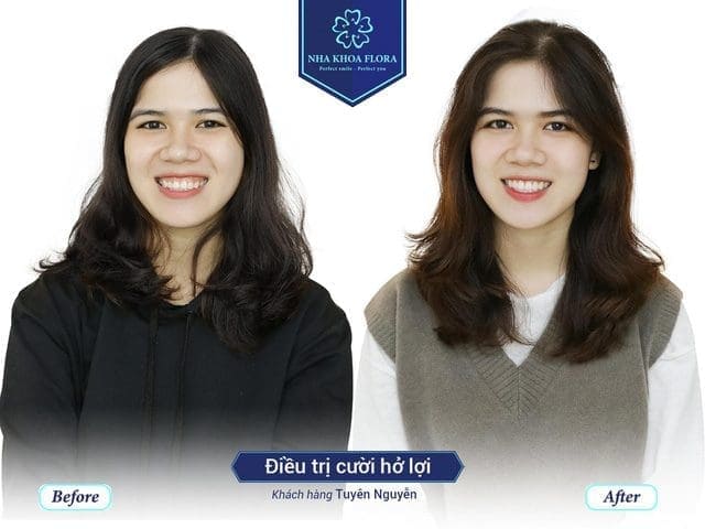 khach-hang-hai-long-khi-dieu-tri-tai-nha-khoa-flora Khách hàng hài lòng khi điều trị tại nha khoa Flora