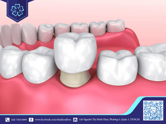 Quá trình bọc răng sứ có nguy hiểm như bạn nghĩ? 3