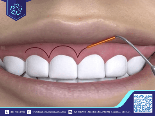 Chữa cười hở lợi có nguy hiểm không là câu hỏi được nhiều khách hàng quan tâm nhiều nhất Chữa cười hở lợi có nguy hiểm không là câu hỏi được nhiều khách hàng quan tâm nhiều nhất