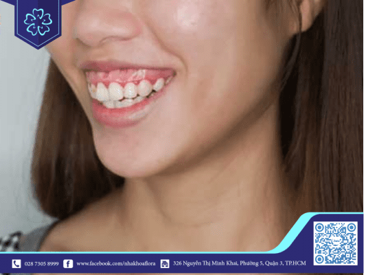 Cười hở lợi có tốt không? Cười hở lợi có tốt không?