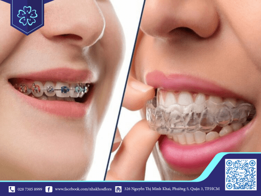 khop-can-duoc-dieu-chinh-bang-nieng-rang Khớp cắn được điều chỉnh bằng niềng răng