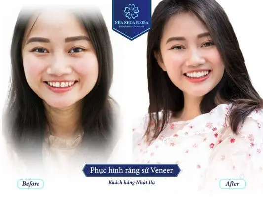 THỜI GIAN KIỂM TRA ĐỊNH KỲ SAU KHI BỌC RĂNG SỨ 2
