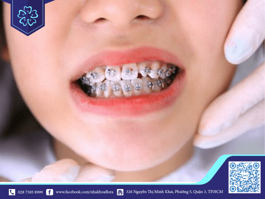 kinh-nghiem-nieng-rang-mac-cai-thoi-gian-dau-va-siet-rang-se-gay-cam-giac-e-dau Kinh nghiệm niềng răng mắc cài thời gian đầu và siết răng sẽ gây cảm giác ê đau (ảnh minh họa)