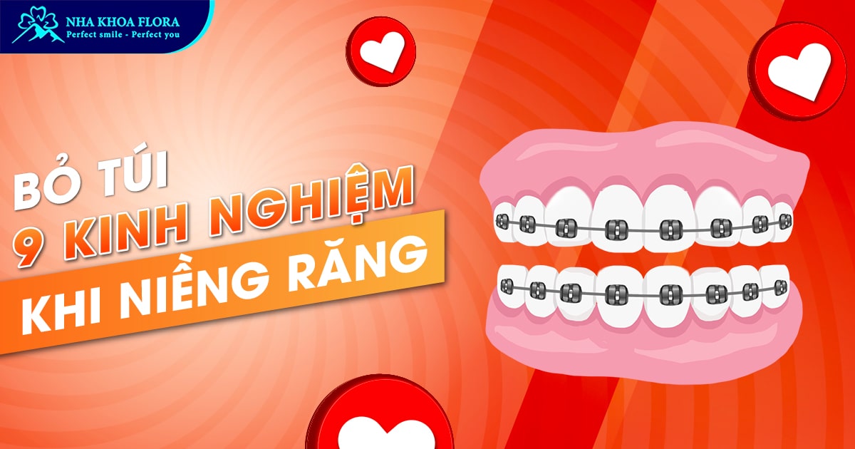 Chia sẻ kinh nghiệm niềng răng cho người muốn thực hiện