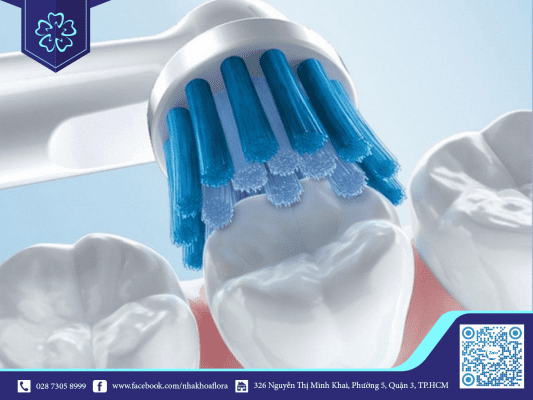 Lưu ý khi niềng răng invisalign 5