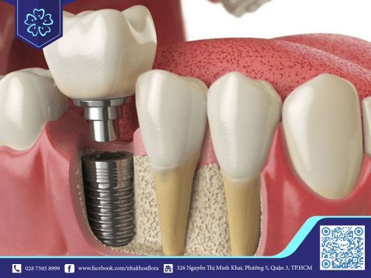 Mức độ cấy ghép implant cấp độ mô phù hợp với răng hàm trong