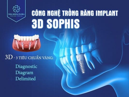 đối tượng chỉ định: Công nghệ 3D Sophis trồng răng implant