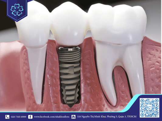 nguyen-nhan-rang-implant-lung-lay-co-the-do-long-khop-noi Nguyên nhân răng Implant lung lay có thể do lỏng khớp nối (ảnh minh họa)