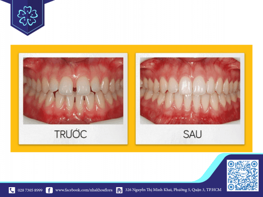 dieu-tri-rang-thua-bang-invisalign Điều trị răng thưa bằng Invisalign