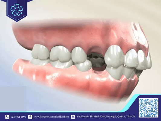 nho-rang-truoc-khi-nieng-giup-rang-dich-chuyen-on-dinh Nhổ răng trước khi niềng giúp răng dịch chuyển ổn định (ảnh minh họa)