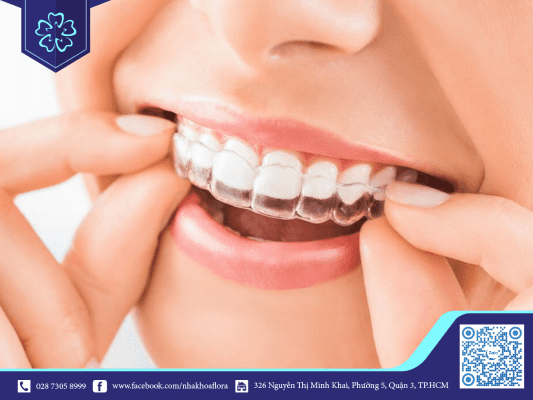nieng-rang-giup-dich-chuyen-rang-ve-dung-vi-tri Niềng răng giúp dịch chuyển răng về đúng vị trí (ảnh minh họa)