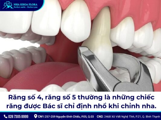 niềng răng trong suốt có phải nhổ răng không - ảnh 3 niềng răng trong suốt có phải nhổ răng không - ảnh 3