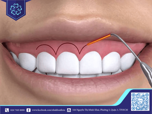 Cắt lợi chữa cười hở lợi (ảnh minh họa) Cắt lợi chữa cười hở lợi (ảnh minh họa)