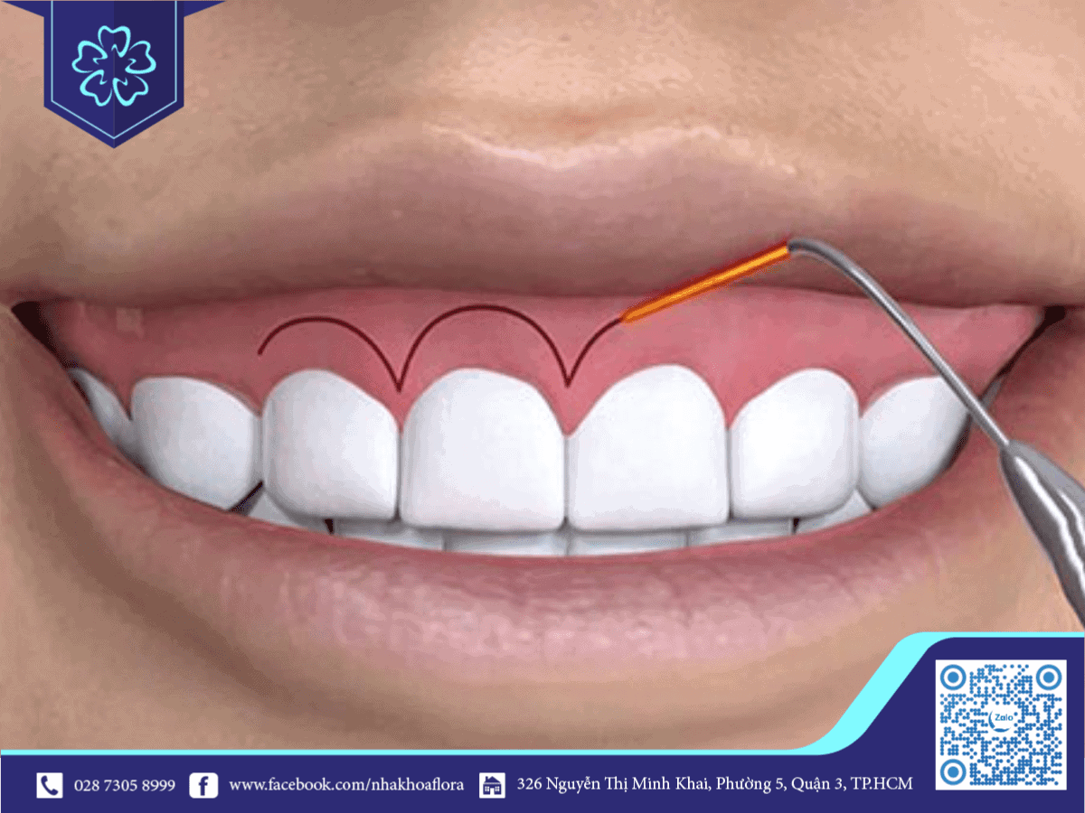 Kỹ thuật phẫu thuật cười hở lợi an toàn và hiệu quả phổ biến hiện nay