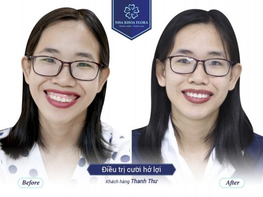 nha-khoa-flora-nha-khoa-phau-thuat-cuoi-ho-loi-uy-tin Nha khoa Flora - Nha khoa phẫu thuật cười hở lợi uy tín