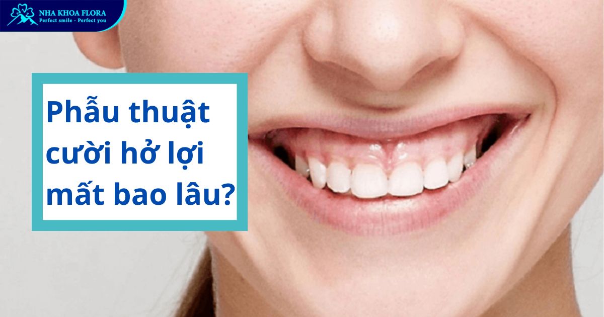 Phẫu thuật cười hở lợi mất bao lâu thì xong?