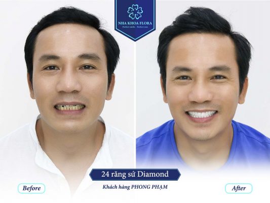 ket-qua-khach-hang-boc-rang-su-cung-bac-si-minh Kết quả khách hàng bọc răng sứ cùng bác sĩ Minh