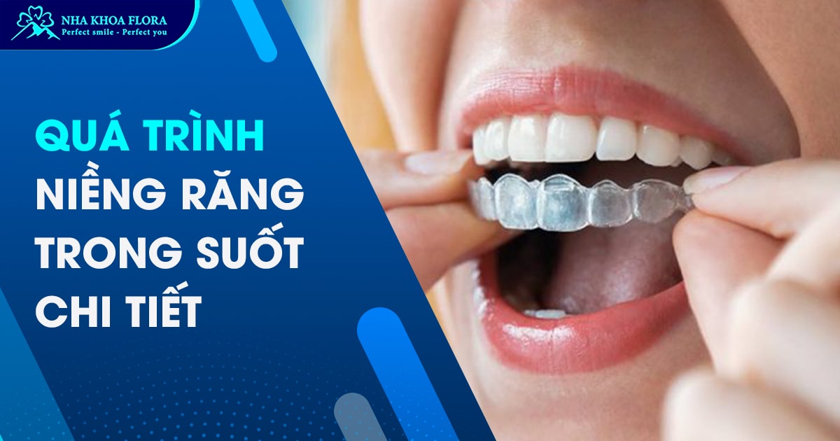 Quá trình niềng răng trong suốt diễn ra như thế nào?