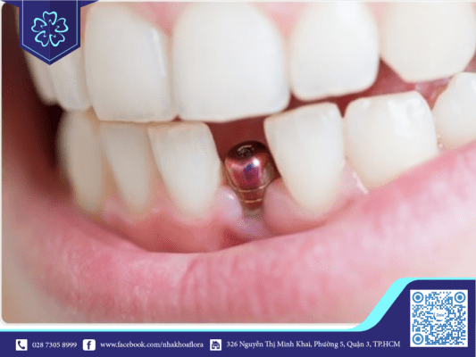 Quy trình cấy Implant thường kéo dài từ 3 tuần đến 3 tháng (ảnh minh họa) Quy trình cấy implant thường kéo dài từ 3 tuần đến 3 tháng (ảnh minh họa)