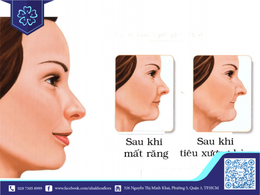 da-mat-bi-chay-xe-sau-mot-thoi-gian-mat-rang Da mặt sẽ bị chảy xệ khi bị mất răng một thời gian (ảnh minh họa)