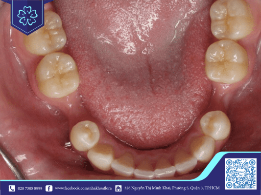 Khi răng bị mất không trồng răng implant sớm sẽ gây ra tình trạng tiêu xương (ảnh minh họa)