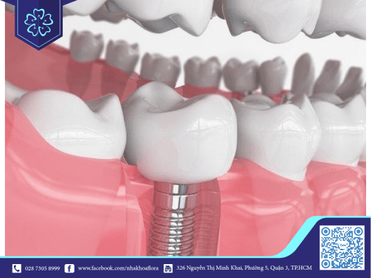 Trồng răng implant giúp răng khỏe mạnh đảm bảo ăn nhai hiệu quả (ảnh minh họa) Trồng răng implant giúp răng khỏe mạnh đảm bảo ăn nhai hiệu quả (ảnh minh họa)