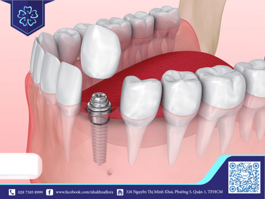 trong-rang-implant-giup-phuc-hoi-rang-so-3-bi-mat-hoan-hao Trồng răng Implant giúp phục hồi răng số 3 bị mất hoàn hảo (ảnh minh họa)