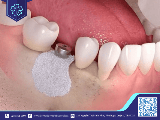 Khi xương hàm bị teo phải ghép xương mới trồng được răng Implant Khi xương hàm bị teo phải ghép xương mới trồng được răng Implant