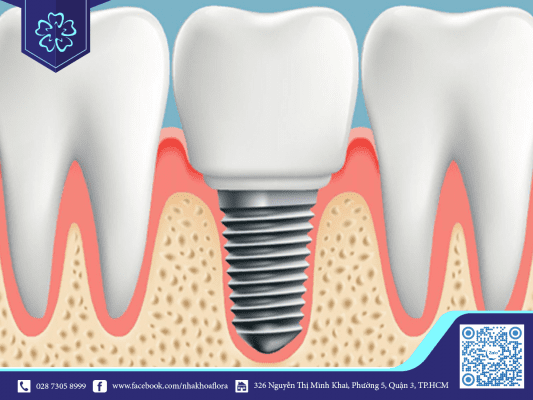 Răng giả Implant theo công nghệ hiện đại của trung tâm Nha Khoa Flora Răng giả Implant theo công nghệ hiện đại của trung tâm Nha Khoa Flora