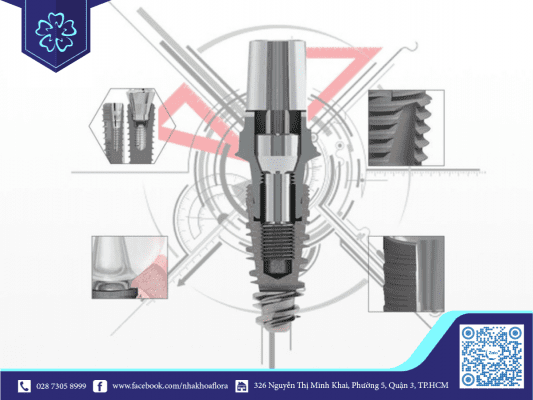 tru-implant-swiss-voi-thiet-ke-khe-xoan-hien-dai-phu-hop-voi-cac-truong-hop-xuong-xop Trụ Implant Swiss với thiết kế khe xoắn hiện đại, phù hợp với các trường hợp xương xốp (ảnh minh họa)