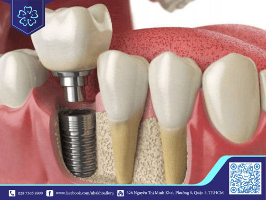 tru-implant-giup-phuc-hoi-rang-bi-mat-hieu-qua Trụ implant giúp phục hồi răng bị mất hiệu quả (ảnh minh họa)