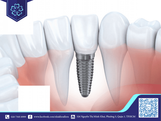 rang-implant-dep-tu-nhien-nhu-rang-that Răng Implant đẹp tự nhiên như răng thật (ảnh minh họa)