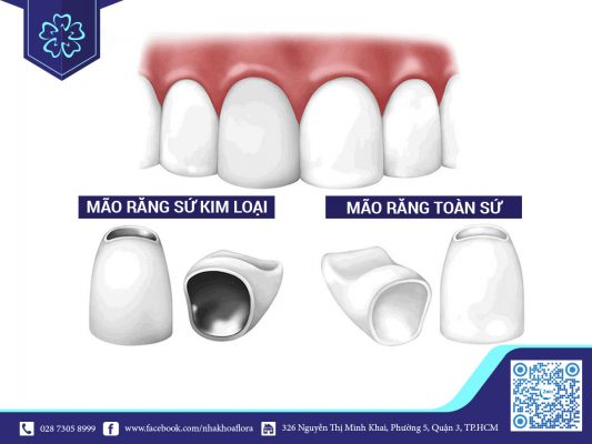 rang-toan-su-co-tuoi-tho-cao-hon-rang-su-kim-loai Răng toàn sứ có tuổi thọ cao hơn răng sứ kim loại