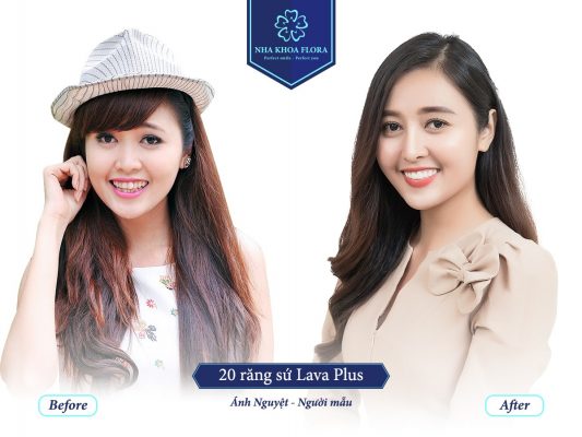 boc-rang-su-tai-nha-khoa-flora Bọc răng sứ tại nha khoa Flora
