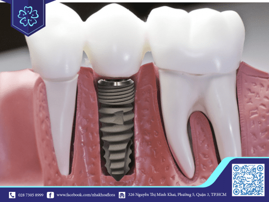 chi-phi-trong-rang-implant-phu-thuoc-vao-loai-tru-rang-duoc-chon Chi phí trồng răng Implant phụ thuộc vào loại trụ răng được chọn