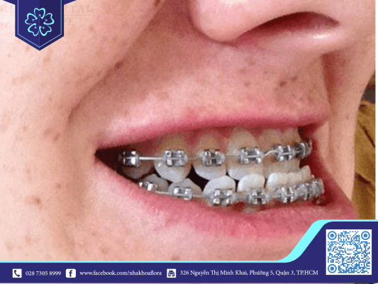 Trẻ bị hàm ngược bao giờ niềng răng được 2