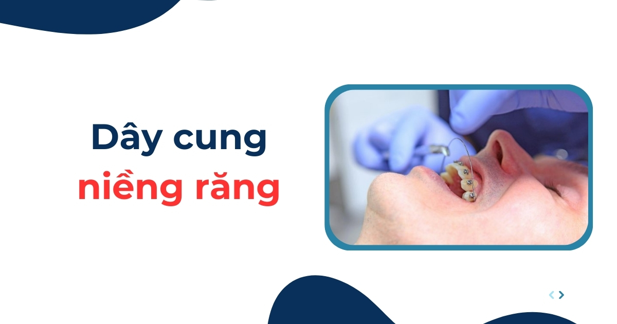 Dây cung niềng răng là gì? Có tác dụng gì? Có mấy loại?