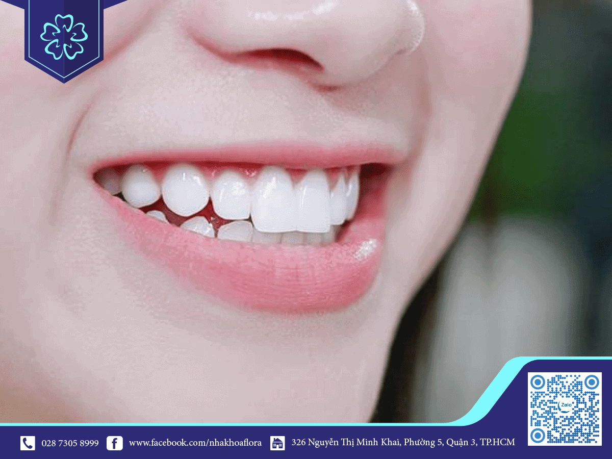 ƯU ĐIỂM PHỦ RĂNG SỨ KHIẾN CÁC NGHỆ SĨ ƯU ÁI LỰA CHỌN