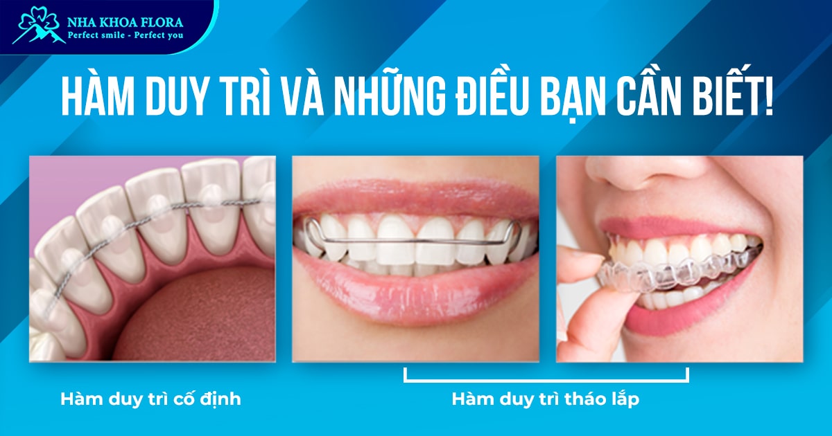 Hàm duy trì là gì? Có mấy loại? Đeo bao lâu? Giá tiền?