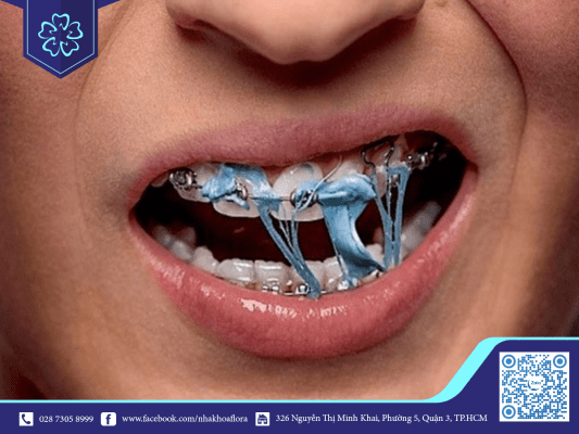 Niềng răng có nên nhai kẹo cao su không? 7