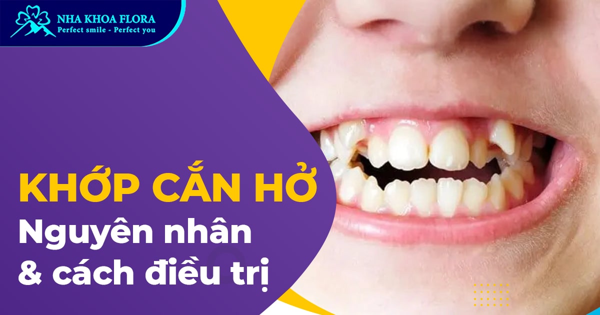 Khớp cắn hở: Nguyên nhân, Tác hại và Cách điều trị