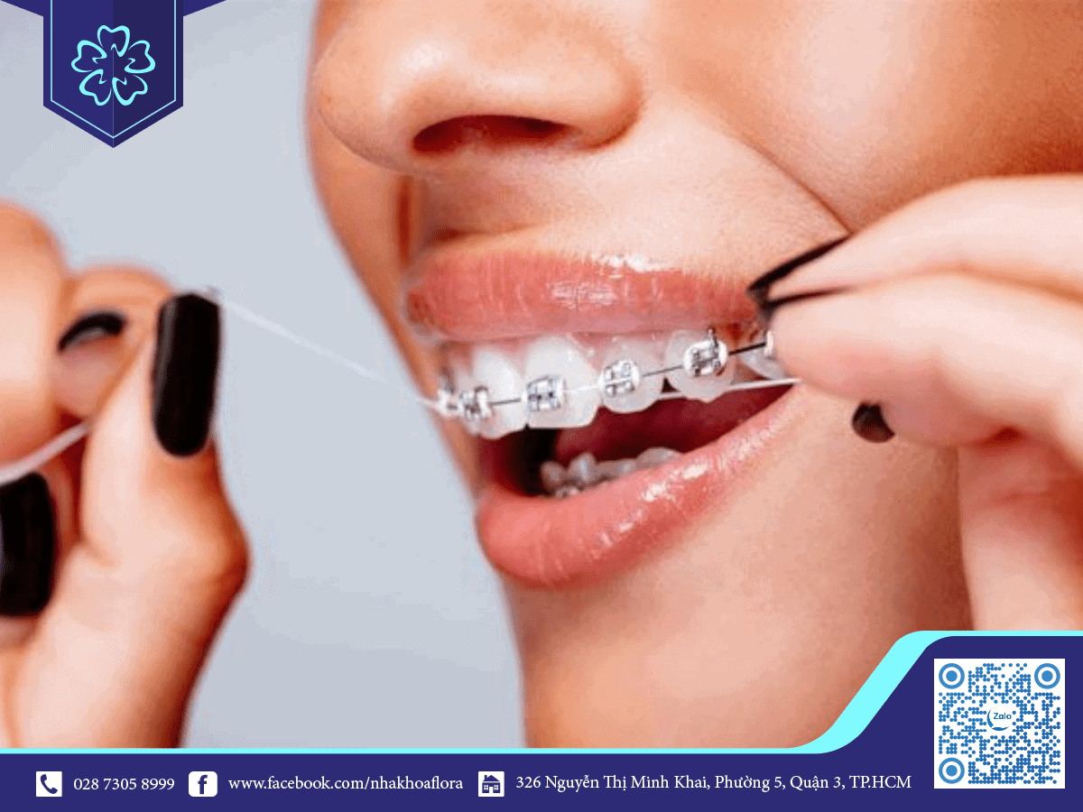 10 điều Chuyên gia khuyến cáo khi thực hiện niềng răng, chỉnh nha