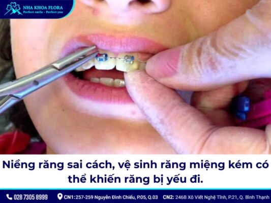 Niềng răng có làm răng yếu đi? - ảnh 3 Niềng răng có làm răng yếu đi? - ảnh 3